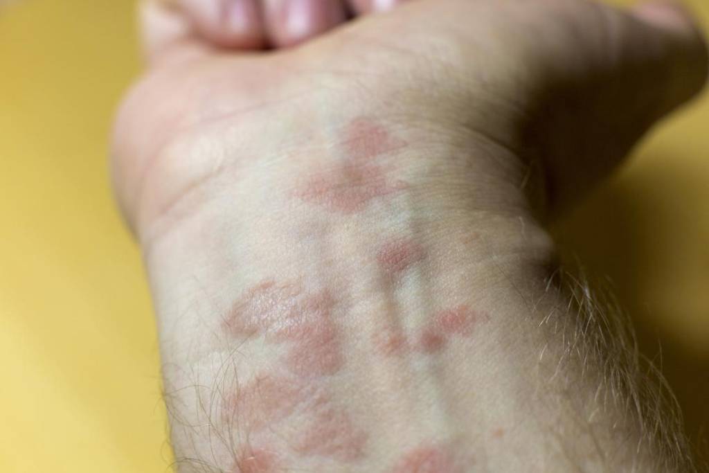 What is Eczema? It's Dermatitis Brilliant Massage & Skin - Burlington &  South Burlington, VT