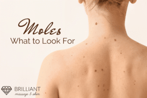 girl with moles on her back: text: moles- what to look for