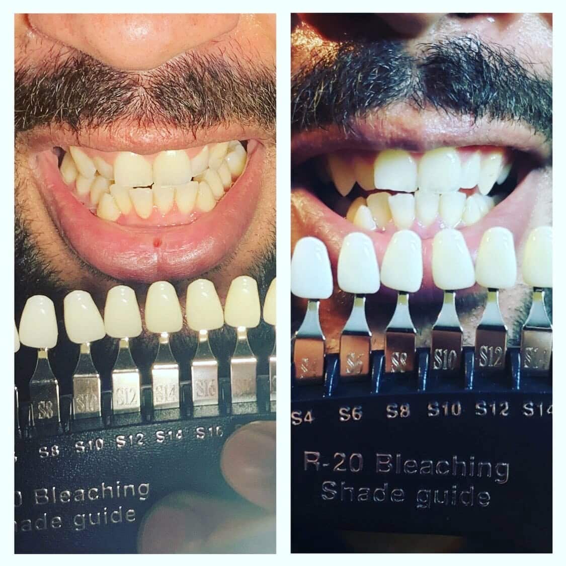 Our clients see 2-7 shades whiter teeth after one treatment. 