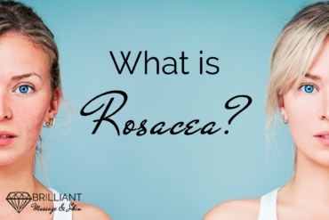 half-faced teens, one with red skinned face while one with clear white skin: text: What is rosacea?